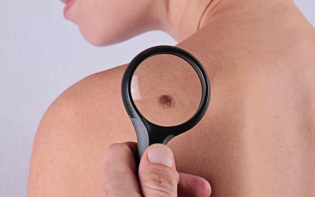 Cancerul de piele – cauze si simptome