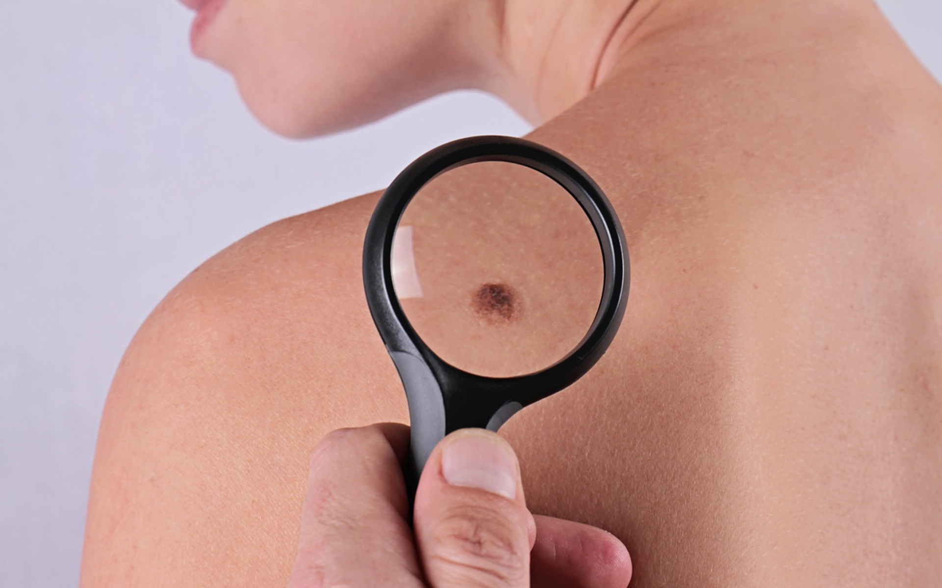 Tipuri de cancer de piele